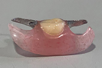 金属のバネのない入れ歯による修復